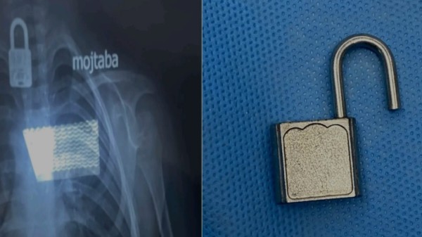 إنجاز طبي في النجف: إنقاذ حياة طفل ابتلع "قفلاً معدنياً" بعملية ناظورية معقدة